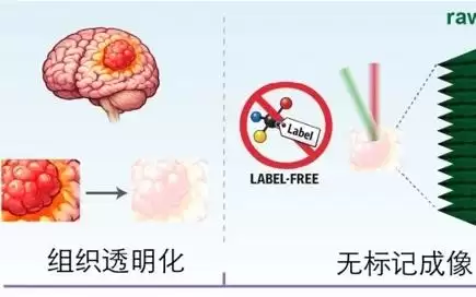 快速生成胶质瘤毫米级三维病理图像,中国学者在《细胞》杂志发文